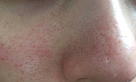 頬のぱっくり開いた毛穴に悩んでいて色んな毛穴ケアをしまくってやっと美肌になれた方法